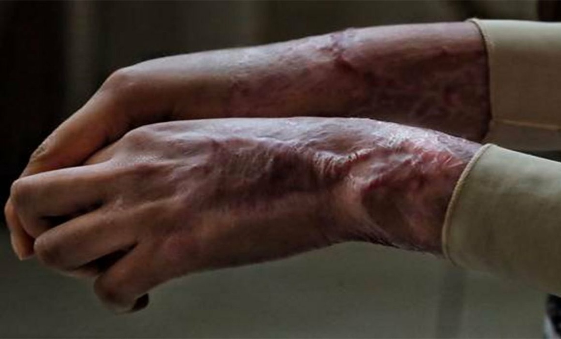Aprueban tipificar como delito lesionar con ácido a mujeres